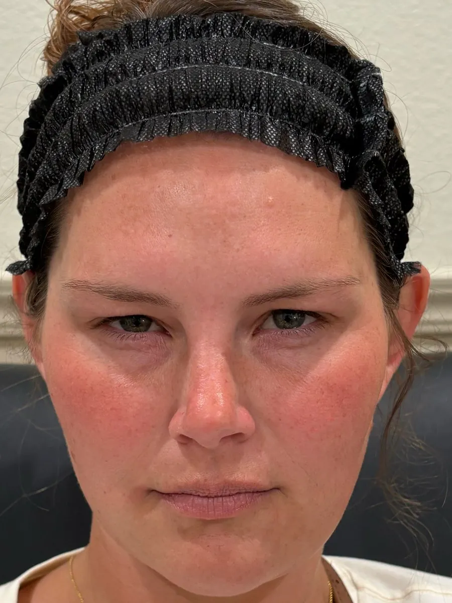After: frown lines after neurotoxin