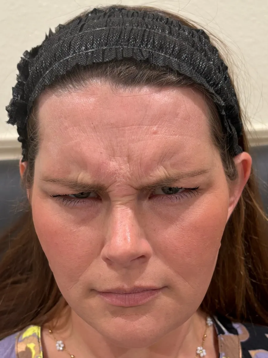Before: frown lines after neurotoxin