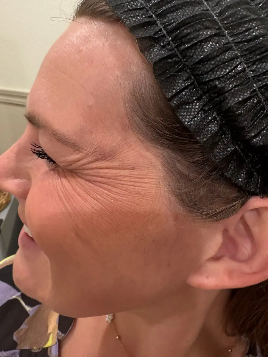 Before: side profile after neurotoxin