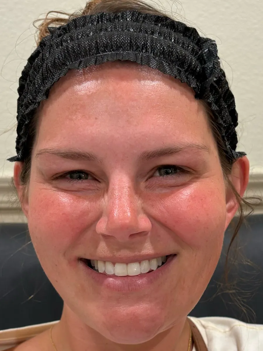 After: crow's feet and smile after neurotoxin