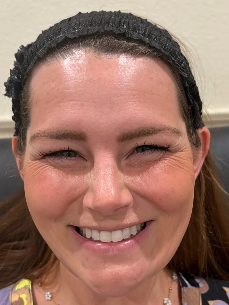 Before: crow's feet and smile after neurotoxin