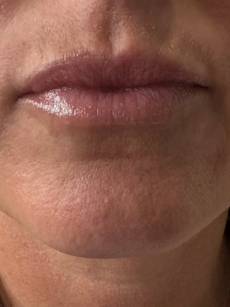 After: lips at rest after lip filler