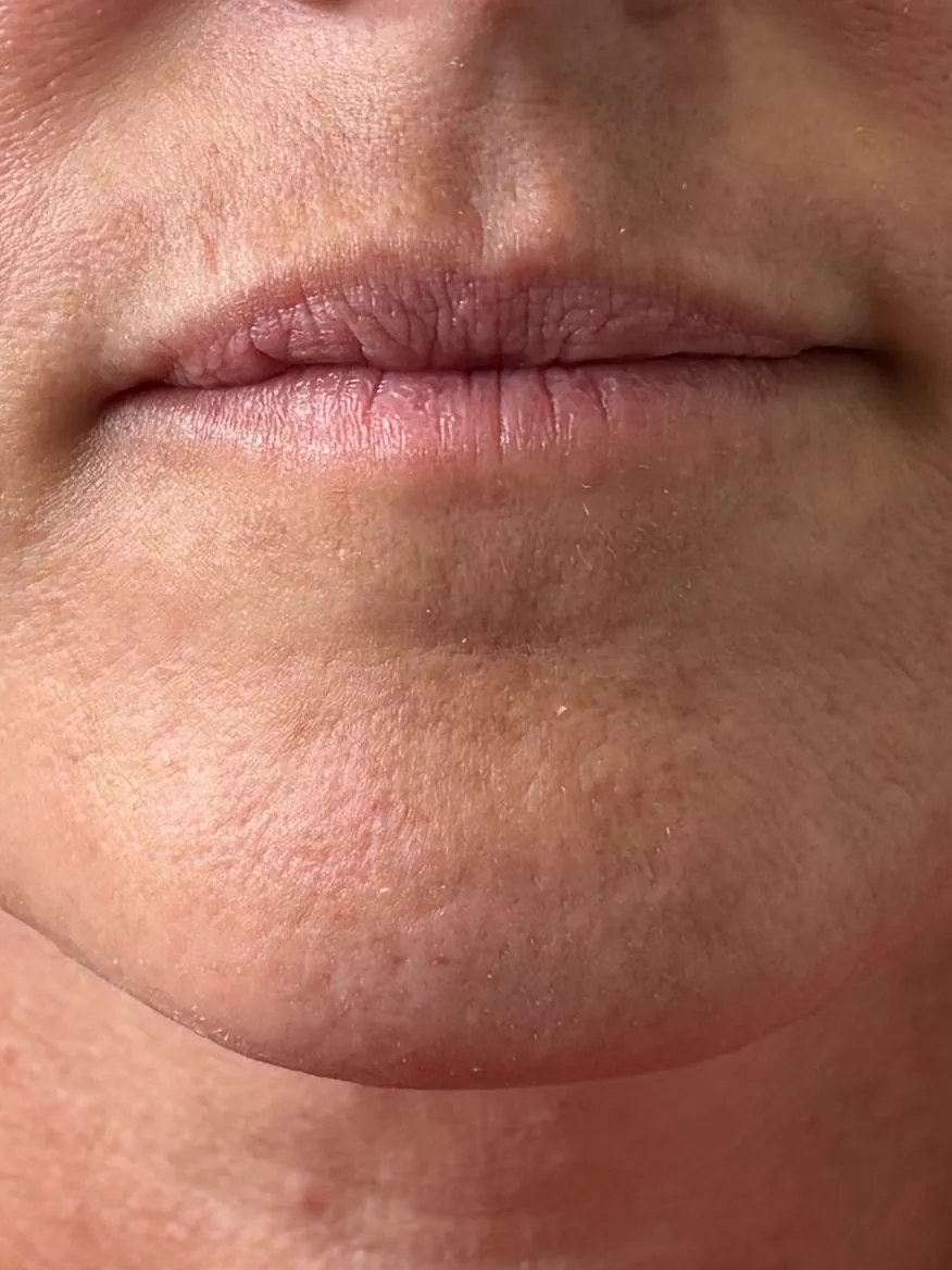 Before: lips at rest after lip filler