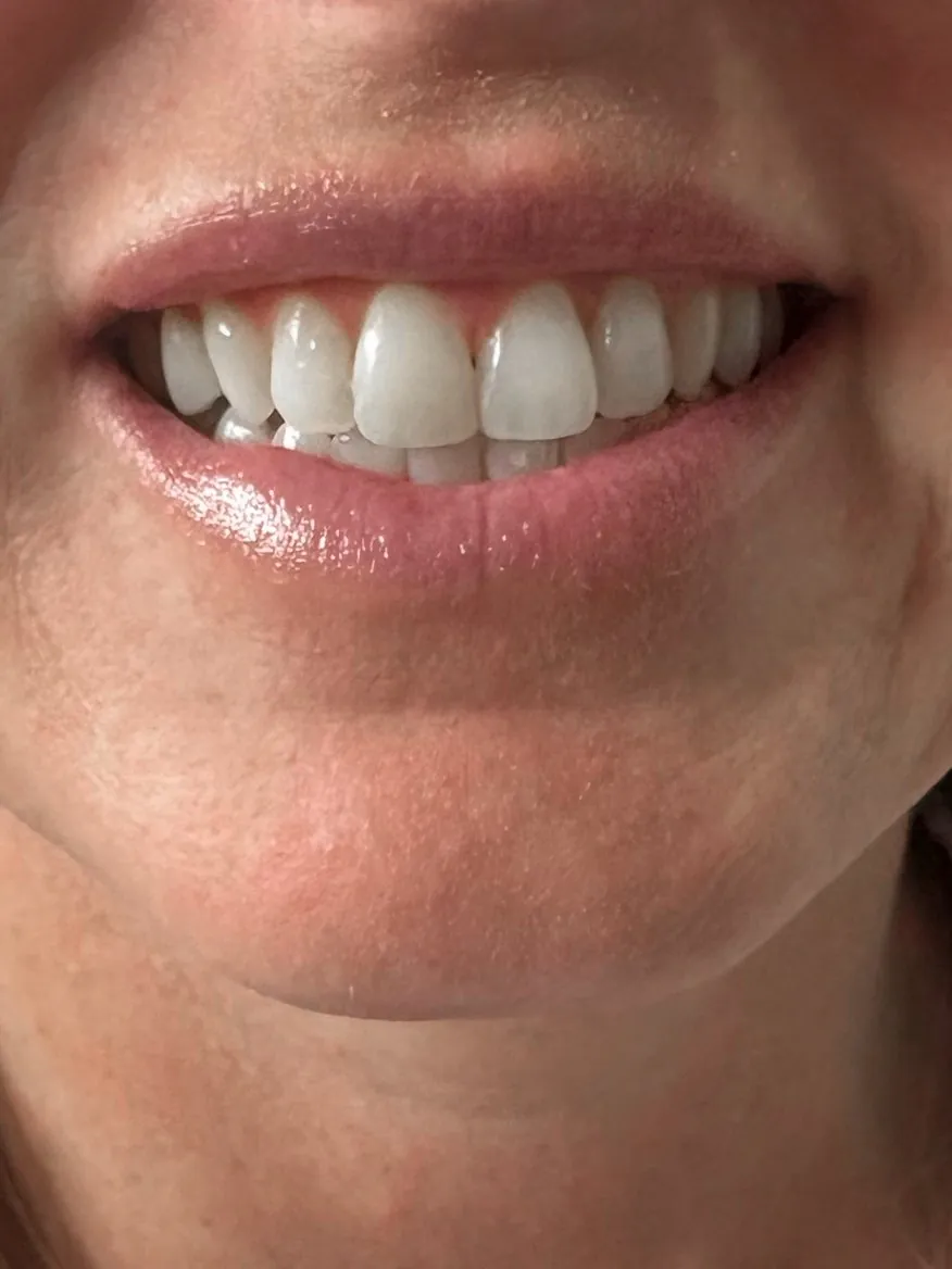 After: full smile after lip filler
