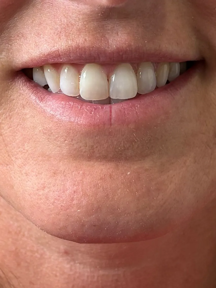 Before: full smile after lip filler