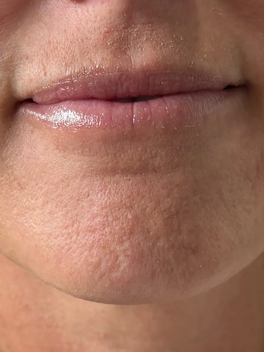 After: soft smile after lip filler