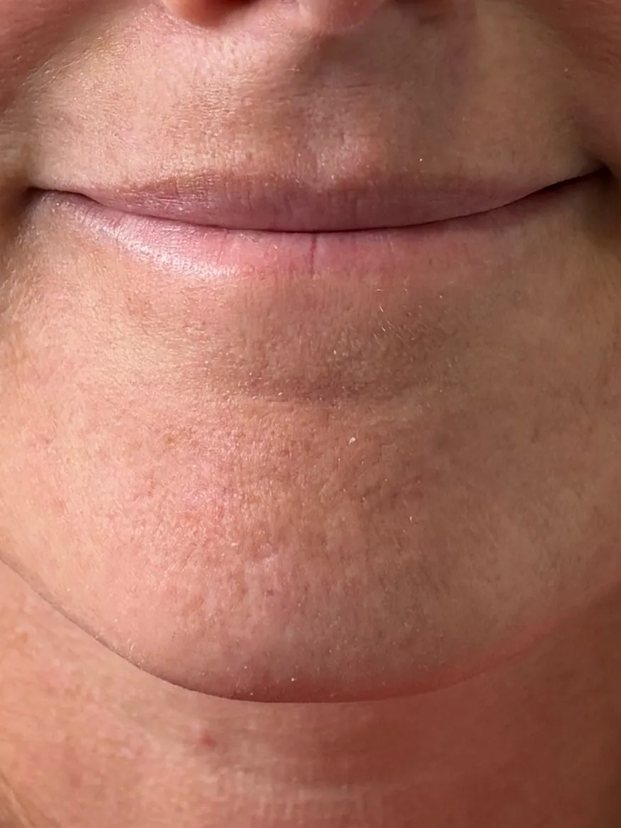 Before: soft smile after lip filler